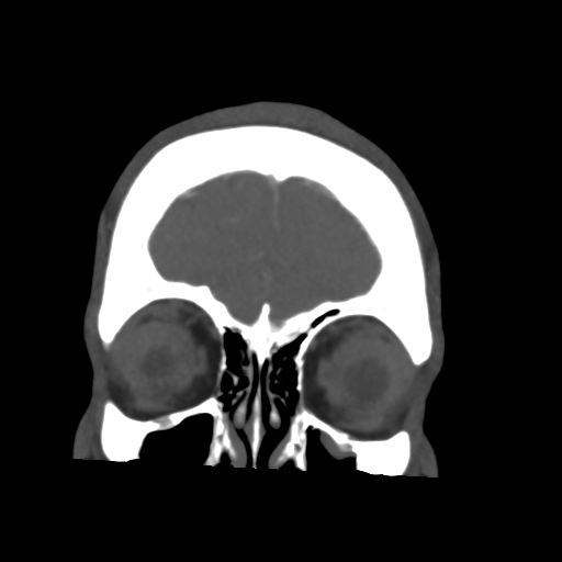 Cerebral arteriovenous malformation (Spetzler-Martin grade 2) (Radiopaedia 41262-44076 F 9).png