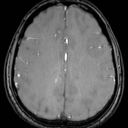 Cerebral arteriovenous malformation at posterior body of corpus callosum (Radiopaedia 74111-84925 Axial MRA 154).jpg