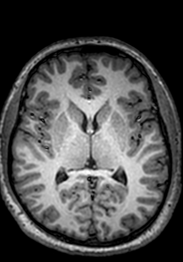 Cerebral arteriovenous malformation at posterior body of corpus callosum (Radiopaedia 74111-84925 Axial T1 141).jpg