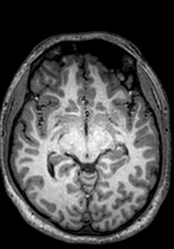 File:Cerebral arteriovenous malformation at posterior body of corpus callosum (Radiopaedia 74111-84925 Axial T1 171).jpg