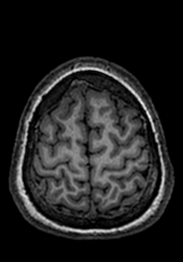 Cerebral arteriovenous malformation at posterior body of corpus callosum (Radiopaedia 74111-84925 Axial T1 32).jpg