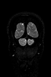 Cerebral arteriovenous malformation at posterior body of corpus callosum (Radiopaedia 74111-84925 Coronal T2 168).jpg