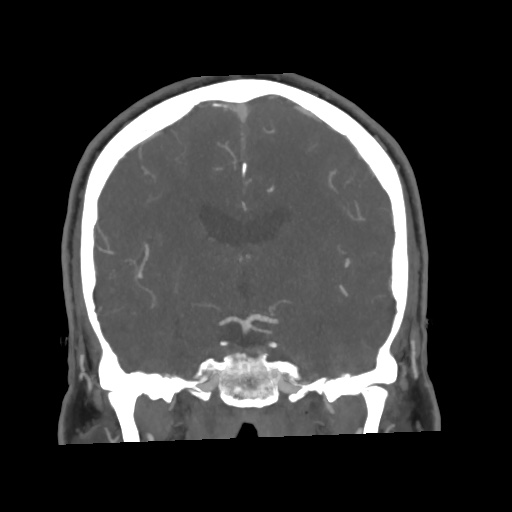 Cerebral arteriovenous malformation with lobar hemorrhage (Radiopaedia 35598-57216 C 47).jpg