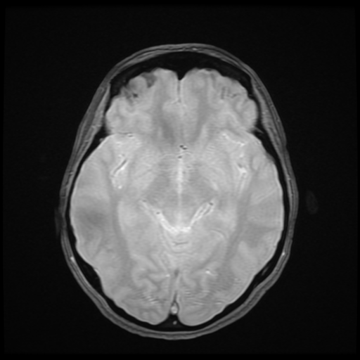 File:Cerebral autosomal dominant arteriopathy with subcortical infarcts and leukoencephalopathy (CADASIL) (Radiopaedia 41018-43768 Ax 2D MERGE 9).png