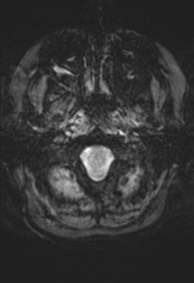 File:Cerebral cavernoma and development venous anomaly (Radiopaedia 37603-39482 Axial SWI 3).png