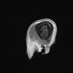 File:Cerebral cavernous venous malformation (Radiopaedia 70008-80021 Sagittal T1 C+ 70).jpg
