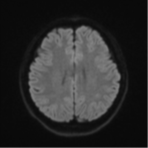 Cerebral cavernous venous malformations (Radiopaedia 48117-52946 Axial DWI 46).png