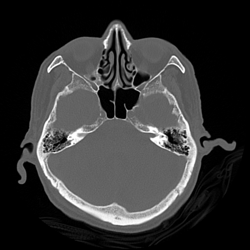 Cerebral contusions, subarachnoid hemorrhage and subdural hygromas (Radiopaedia 55399-61827 Axial bone window 15).png