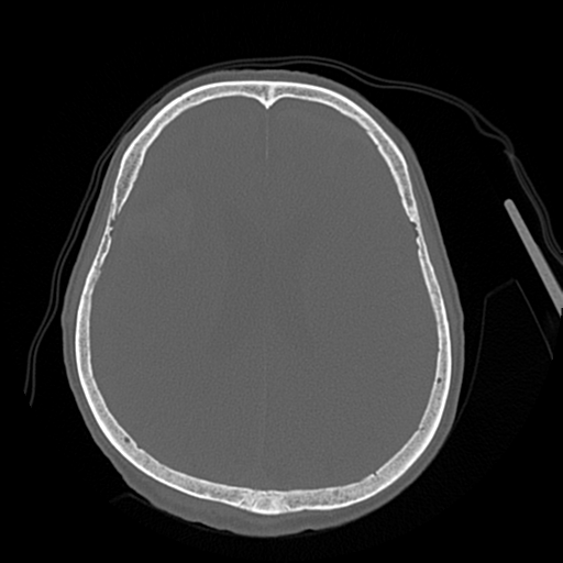 File:Cerebral contusions, subarachnoid hemorrhage and subdural hygromas (Radiopaedia 55399-61827 Axial bone window 33).png