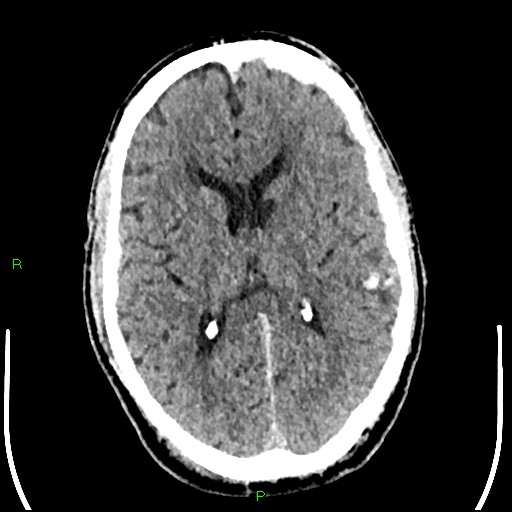 File:Cerebral contusions (Radiopaedia 33868-35039 Axial non-contrast 115).jpg