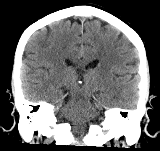 File:Cerebral embolic infarcts (embolic shower) (Radiopaedia 57395-64341 Coronal non-contrast 24).png