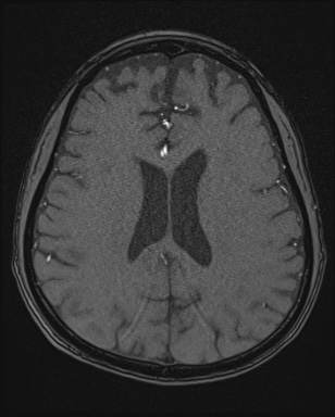 File:Cerebral embolic infarcts (embolic shower) (Radiopaedia 72391-82921 Axial MRA 126).jpg