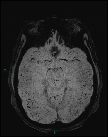 Cerebral fat embolism (Radiopaedia 35022-36525 Axial SWI 6).jpg