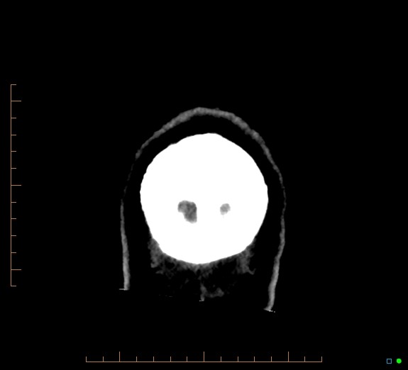 Cerebral fat embolism (Radiopaedia 85521-101224 Coronal non-contrast 62).jpg