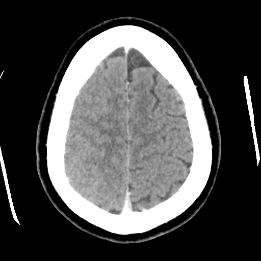 File:Cerebral hemorrhage secondary to arteriovenous malformation (Radiopaedia 33497-34561 B 44).png