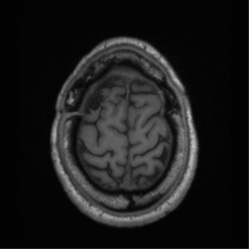 Cerebral hemorrhagic contusions- temporal evolution (Radiopaedia 40224-42757 Axial T1 68).png