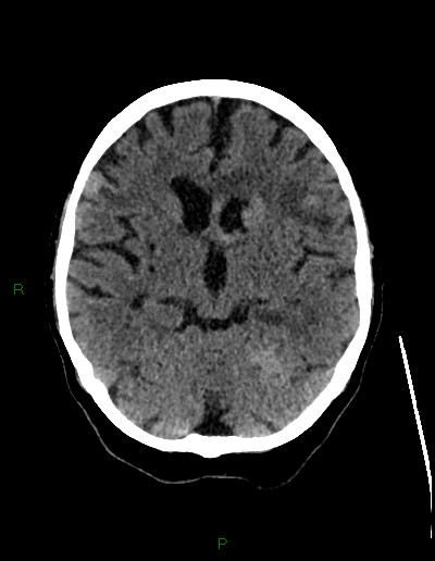 File:Cerebral metastases - ependymal and parenchymal (Radiopaedia 79877-93131 Axial non-contrast 33).jpg