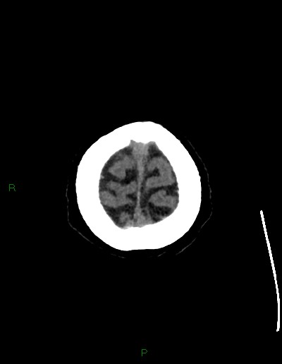 Cerebral metastases - ependymal and parenchymal (Radiopaedia 79877-93131 Axial non-contrast 77).jpg