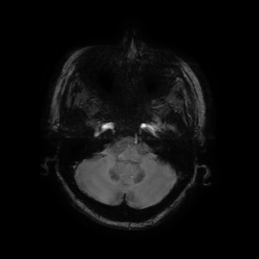 Cerebral metastases - melanoma (Radiopaedia 80972-94522 Axial SWI 22).jpg