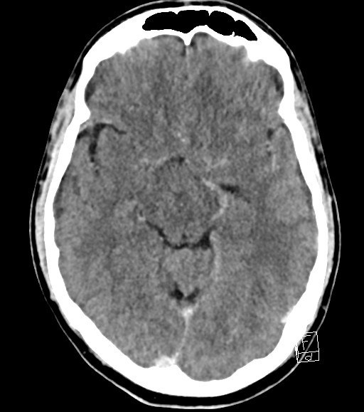 Cerebral metastases - testicular choriocarcinoma (Radiopaedia 84486-99855 Axial C+ delayed 34).jpg