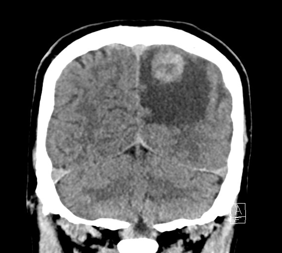 Cerebral metastases - testicular choriocarcinoma (Radiopaedia 84486-99855 Coronal C+ delayed 49).jpg