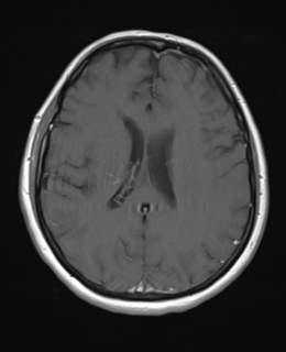 File:Cerebral metastases mimicking abscesses (Radiopaedia 45841-50131 Axial T1 C+ fat sat 18).png