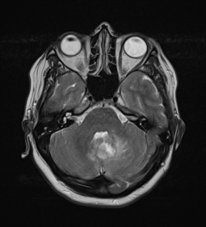 File:Cerebral metastases mimicking abscesses (Radiopaedia 45841-50131 Axial T2 9).png