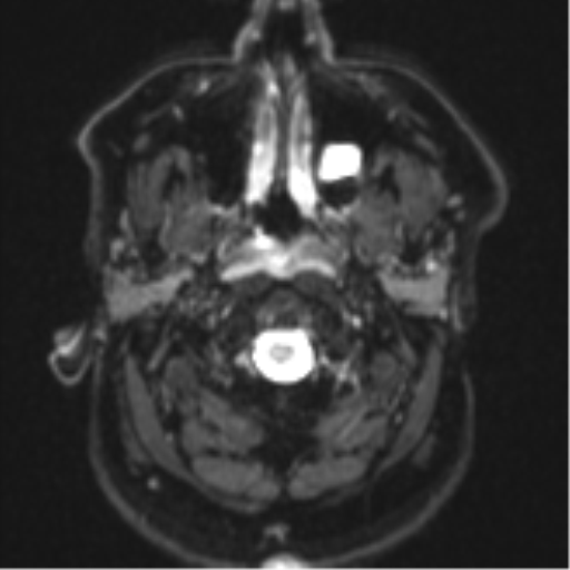 Cerebral metastases mimicking multifocal glioblastoma (Radiopaedia 50843-56353 Axial DWI 1).png