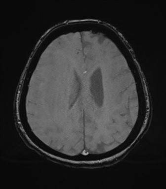 Cerebral metastasis to basal ganglia (Radiopaedia 81568-95413 Axial SWI magnitude 61).png