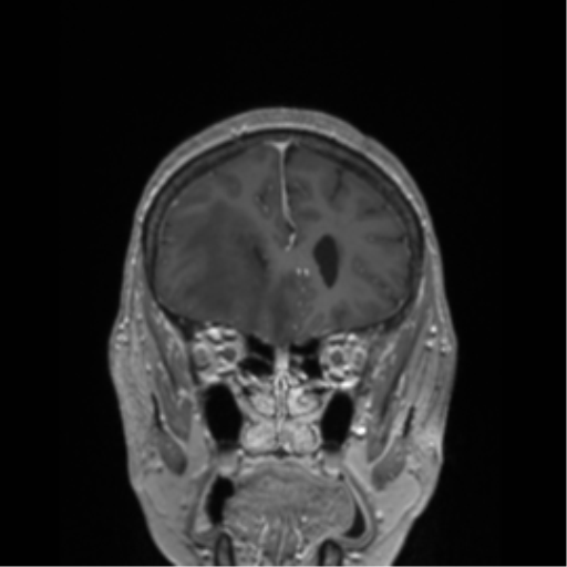 File:Cerebral metastasis to basal ganglia (Radiopaedia 81568-95413 Coronal T1 C+ 48).png