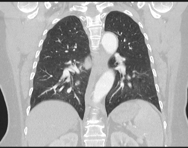 Cerebral metastasis to basal ganglia (Radiopaedia 81568-95414 Coronal lung window 56).png