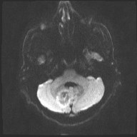 File:Cerebral toxoplasmosis (Radiopaedia 43956-47461 Axial DWI 5).jpg