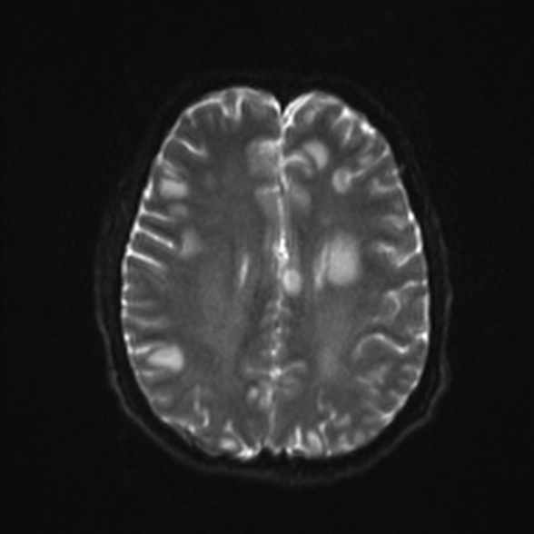 Cerebral toxoplasmosis (Radiopaedia 53993-60132 Axial DWI 18).jpg