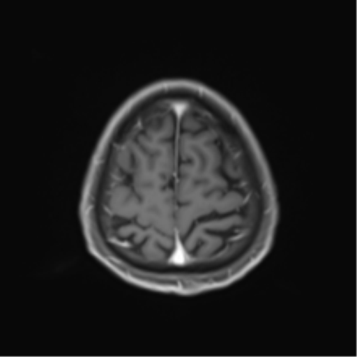 Cerebral toxoplasmosis (Radiopaedia 54575-60804 Axial T1 C+ 47).png