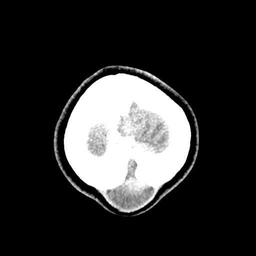 Cerebral tuberculosis with dural sinus invasion (Radiopaedia 60353-68018 Axial non-contrast 61).jpg