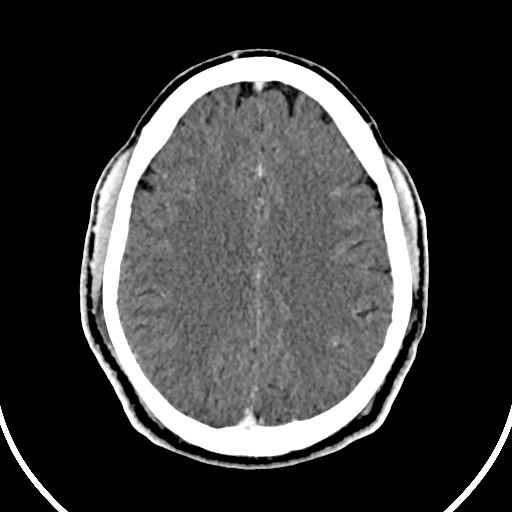 File:Cerebral venous angioma (Radiopaedia 69959-79977 B 68).jpg