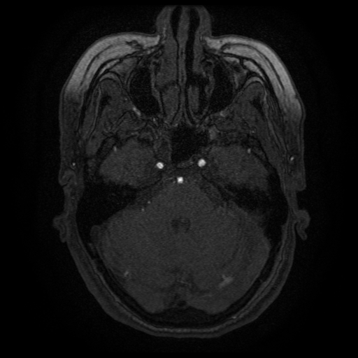 Cerebral venous infarction (Radiopaedia 25109-25363 MRA 22).jpg