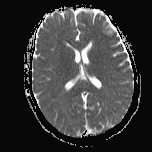 File:Cerebral venous infarction - hemorrhagic (Radiopaedia 81625-95505 Axial ADC 13).jpg