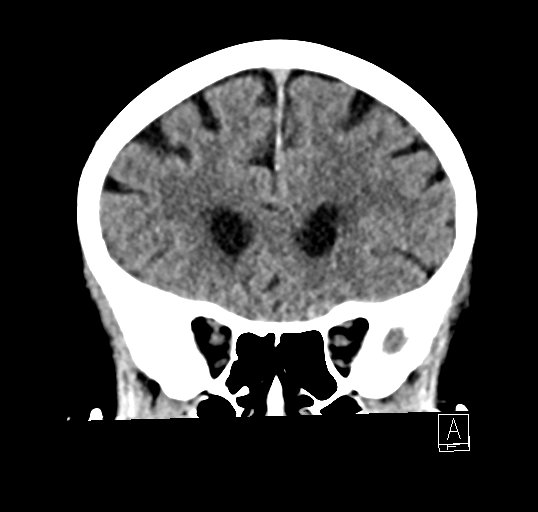 File:Cerebral venous infarction with hemorrhage (Radiopaedia 65343-74381 Coronal non-contrast 14).jpg