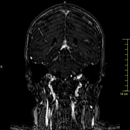Cerebral venous thrombosis (Radiopaedia 23288-23351 MRV 101).JPG