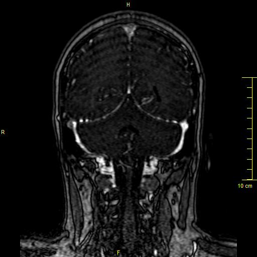 Cerebral venous thrombosis (Radiopaedia 23288-23351 MRV 120).JPG
