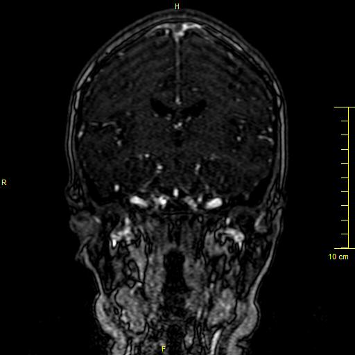 Cerebral venous thrombosis (Radiopaedia 23288-23351 MRV 77).JPG