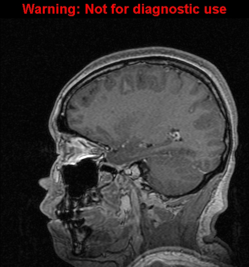 Cerebral venous thrombosis (Radiopaedia 37224-39208 Sagittal T1 C+ 55).jpg