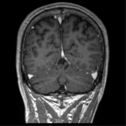Cerebral venous thrombosis (Radiopaedia 38392-40469 Coronal T1 C+ 20).png