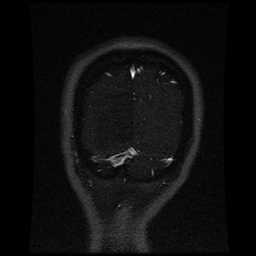 Cerebral venous thrombosis - ulcerative colitis (Radiopaedia 66049-75219 Coronal MRV 16).jpg
