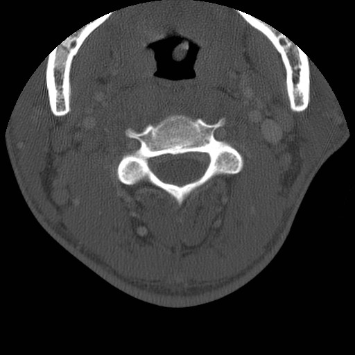 Cervical Pott disease (Radiopaedia 20374-20286 Axial bone window 50).jpg