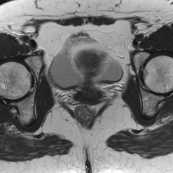 File:Cervical adenocarcinoma (Radiopaedia 65011-73985 Axial T2 16).jpg