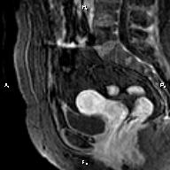File:Cervical adenocarcinoma (Radiopaedia 65011-73985 E 20).jpg
