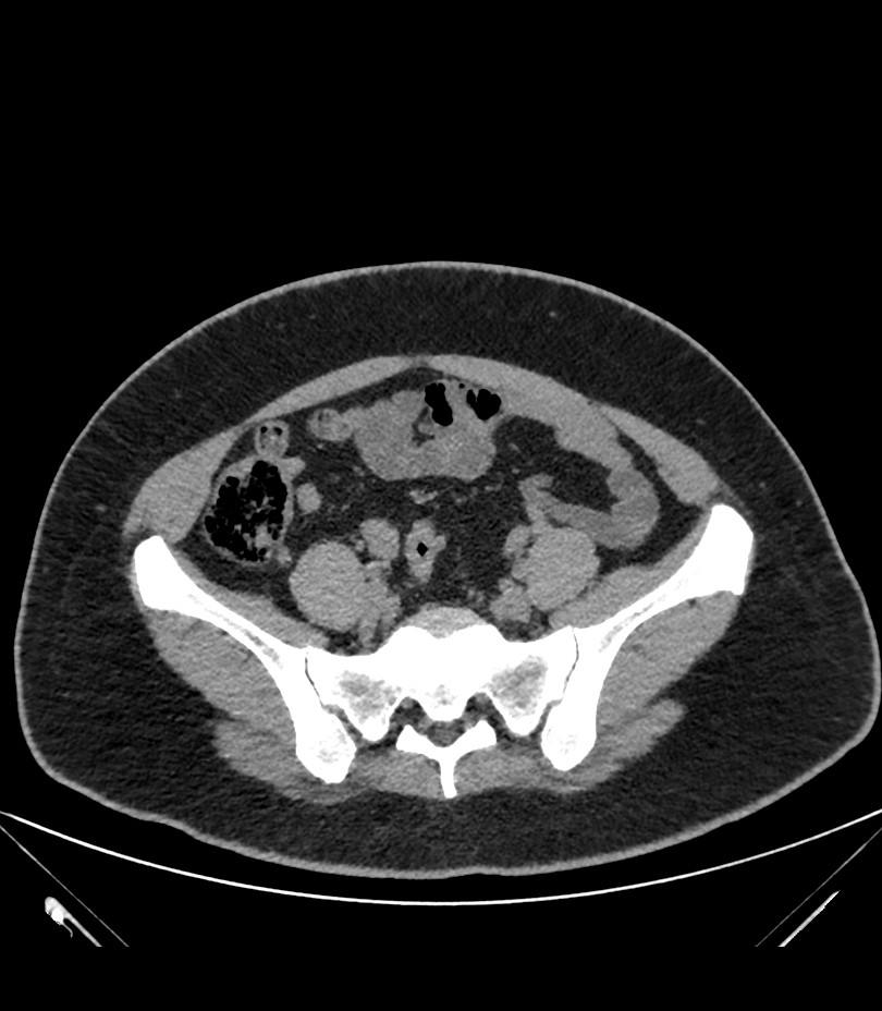Cervical aortic arch with coarctation and aneurysms (Radiopaedia 44035-47552 Axial non-contrast 79).jpg