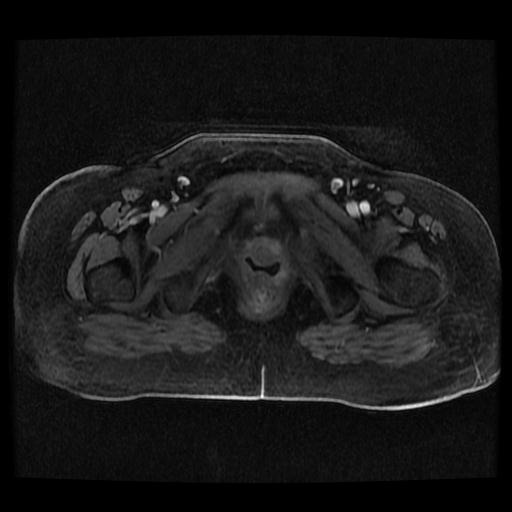 Cervical carcinoma (Radiopaedia 70924-81132 Axial T1 C+ fat sat 27).jpg